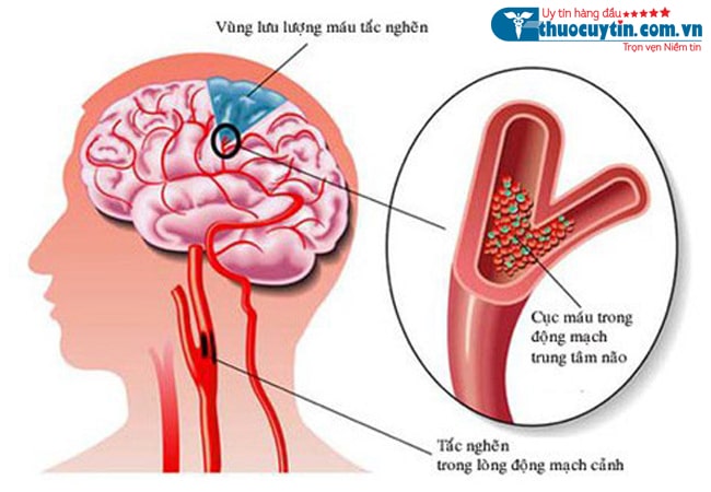 các nguyên nhân gây đột quỵ
