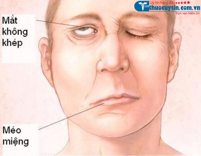 Biểu hiện méo miệng, cơ mặt của bệnh đột quỵ