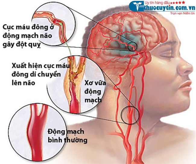 hình thành cục máu đông gây đột quỵ não