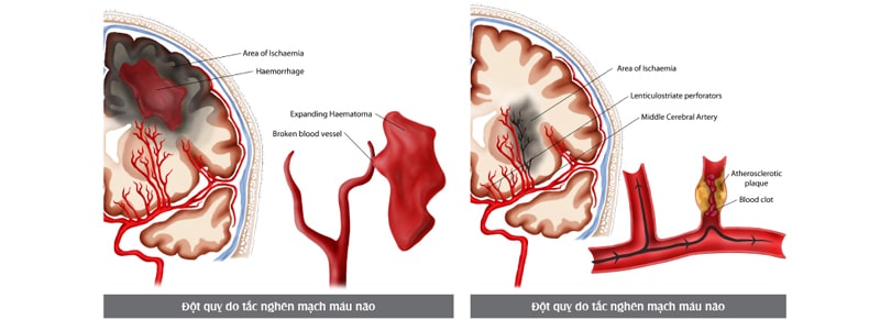 đột quỵ do tắc nghẽn mạch máu não