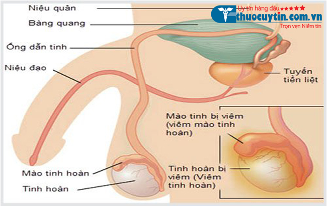 Viêm mào tinh hoàn có chữa khỏi được không