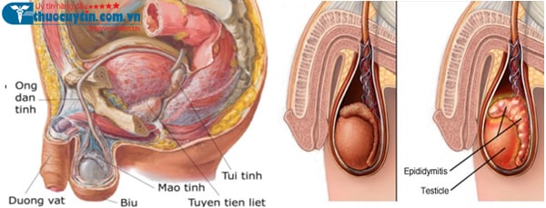 cách điều trị bệnh nang mào tinh hoàn