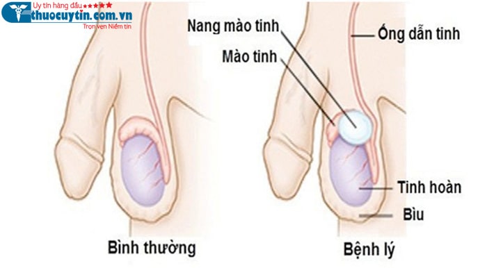 nang mào tinh hoàn là bệnh gì?