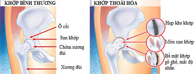 Thuốc Omexxel Arthri