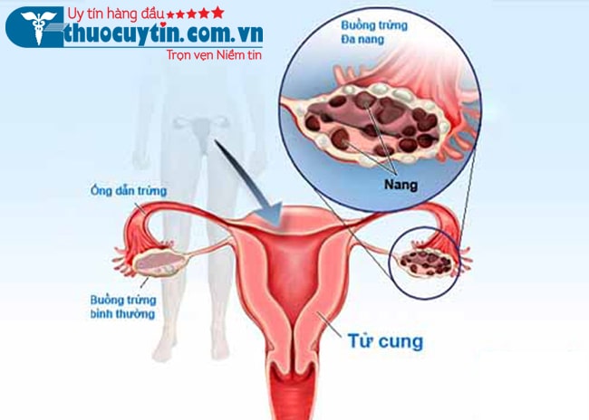 Buồng trứng đa nang là gì? Có nguy hiểm không?