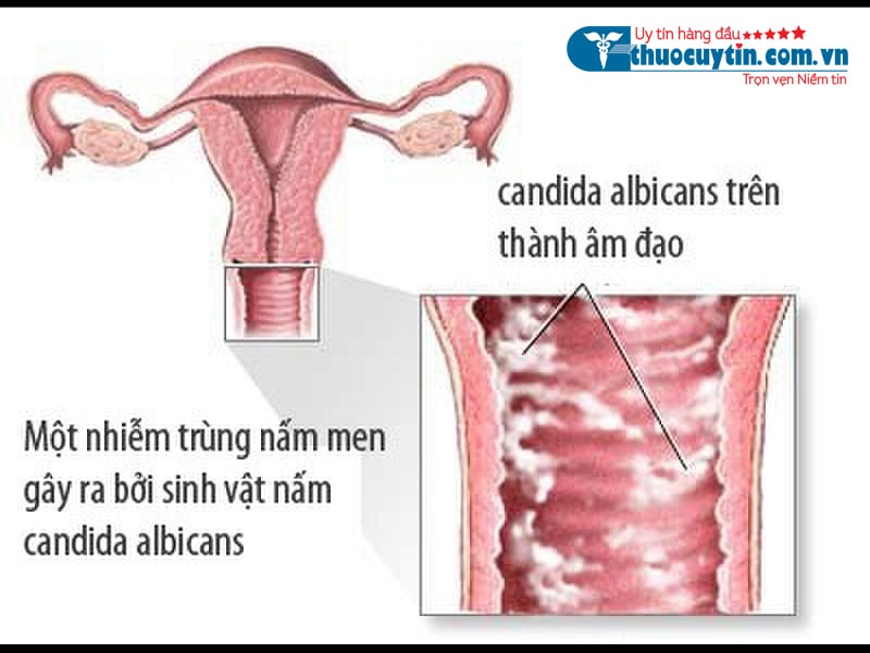 HÌnh ảnh nấm candida trên thành âm đạo