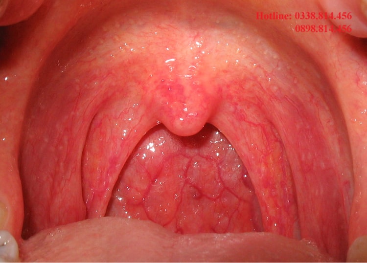 Nước súc miệng SMC Ag+ giúp phòng ngừa viêm họng hiệu quả